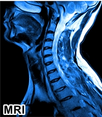 2nd MRI Opinion C Spine