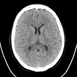 CT scan - Brain and Spine - 2nd Opinion