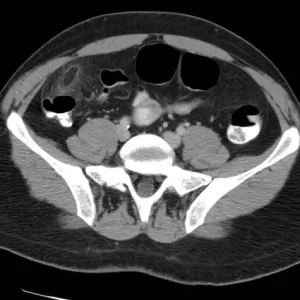 CT scan - Thorax, Abdomen, Pelvis and Prostate - 2nd Opinion