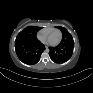 CTA CTV - 2nd Opinion