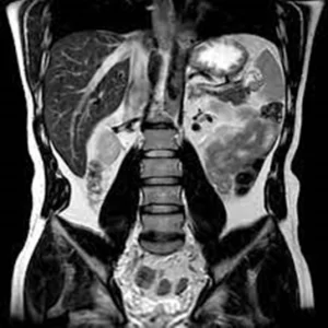 MRI - Abdomen, Pelvis and Prostate - 2nd Opinion